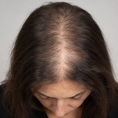 Calvície feminina