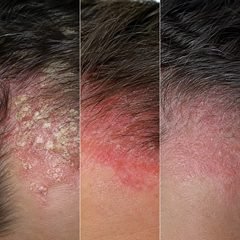 Dermatite e sensibilidade